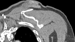 Malignant fibrous histiocytoma (MFH) of Trapezius Muscle - CTisus CT Scan