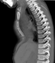 Pectus Deformity - CTisus CT Scan