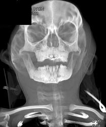 3D of the Face With Mandibular Fracture - CTisus CT Scan