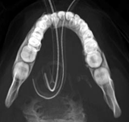 Mandibular Fracture - CTisus CT Scan