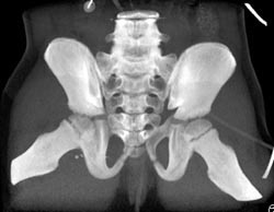 Right Symphysis Fracture - CTisus CT Scan