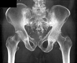 Stress Fractures - CTisus CT Scan