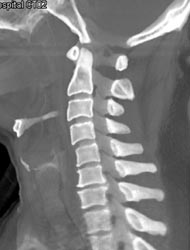 Degenerative Joint Disease (DJD) C-spine - CTisus CT Scan