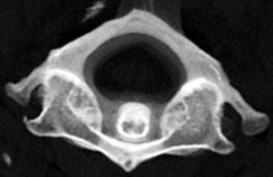 Odontoid - CTisus CT Scan