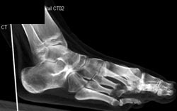 Tarsal Coalition - CTisus CT Scan