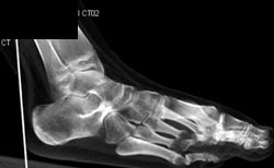 Tarsal Coalition - CTisus CT Scan