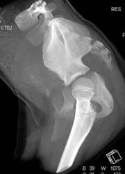 Normal Acetabulum - CTisus CT Scan