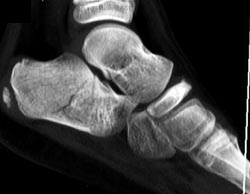 Calcaneal Fracture - CTisus CT Scan