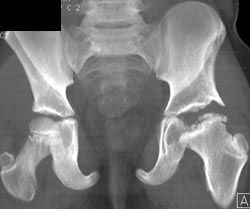 Slipped Capital Femoral Epiphysis (SCFE) With Avascular Necrosis (AVN) - CTisus CT Scan