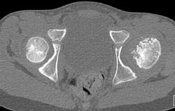 Slipped Capital Femoral Epiphysis (SCFE) - CTisus CT Scan