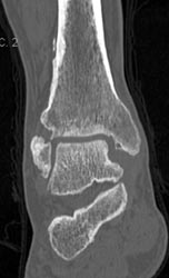 Degenerative Joint Disease (DJD) Ankle - CTisus CT Scan