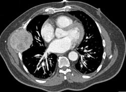 Chest Wall Metastases From Renal Cancer - CTisus CT Scan