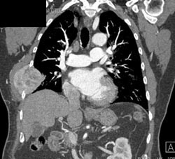 Chest Wall Metastases - CTisus CT Scan