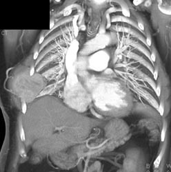 Chest Wall Metastases From Renal Cell Carcinoma - CTisus CT Scan