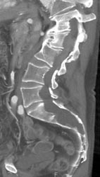 Dural Ectasia - CTisus CT Scan