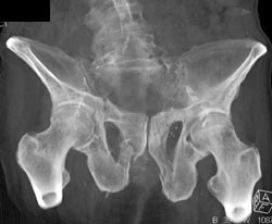 Symphysis Stress Fractures - CTisus CT Scan