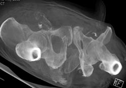 Stress Fractures Symphysis and Sacrum - CTisus CT Scan