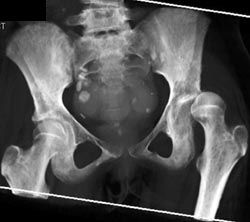 Infection Left Hip Joint - CTisus CT Scan