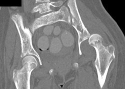 Destruction Left Acetabulum With Infection - CTisus CT Scan