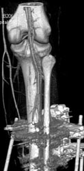 Ct Angiogram of the Knee - CTisus CT Scan