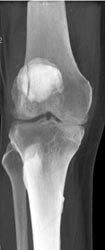 Patella Fracture - CTisus CT Scan