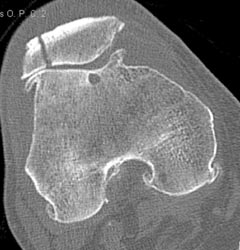 Patella Fracture With Degenerative Joint Disease (DJD) - CTisus CT Scan