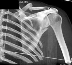 Scapular and Clavicular Fractures - CTisus CT Scan