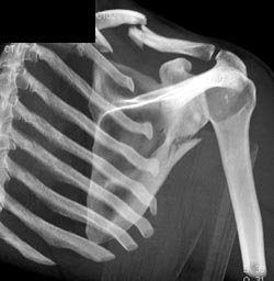 Clavicular and Scapular Fractures - CTisus CT Scan