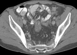 Sacral Osteomyelitis With Soft Tissue Mass in Patient With Crohn's ...