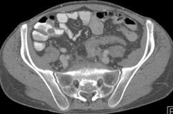 Osteomyelitis L5-s1 Due to Crohn's Disease - CTisus CT Scan