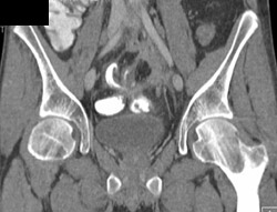 Infected Disc Space at L5-s1 - CTisus CT Scan