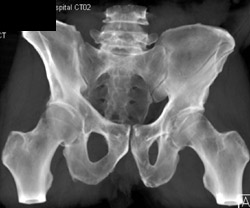 Left Iliac and Ischial Fractures - CTisus CT Scan