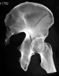 Iliac Wing Fracture - CTisus CT Scan