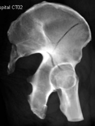 Iliac Wing and Acetabular Fracture - CTisus CT Scan