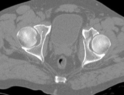 Fracture Anterior Column - CTisus CT Scan