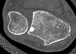 Bone Islands in Radius and Ulna - CTisus CT Scan