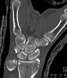 Coronal View Wrist - CTisus CT Scan