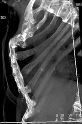 Poor Pectus Repair - CTisus CT Scan