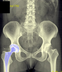 Right Total Hip Replacement - CTisus CT Scan