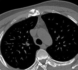 Deformity of Sternum - CTisus CT Scan