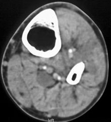 Neurofibromatosis - CTisus CT Scan