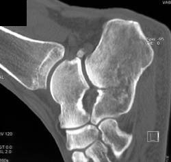 Calcaneal Fracture - CTisus CT Scan