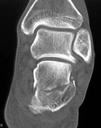 Calcaneal Fracture - CTisus CT Scan