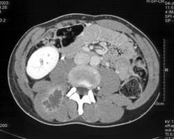 Intramuscular Abscess - CTisus CT Scan