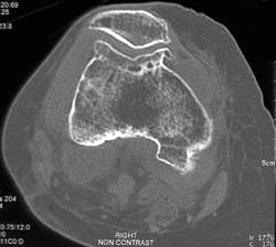 Large Osteophytes - CTisus CT Scan