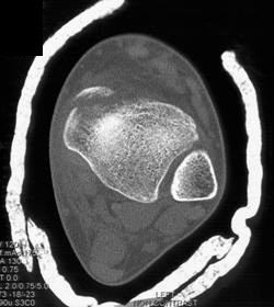 Tibial Fracture - CTisus CT Scan