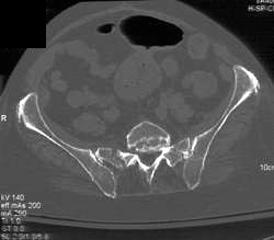 Stress Fracture Sacrum - CTisus CT Scan