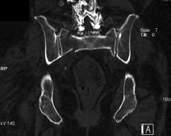 Stress Fracture Sacrum - CTisus CT Scan