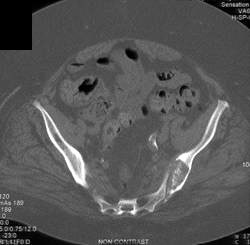 Secondary Hyperparathyroids - CTisus CT Scan