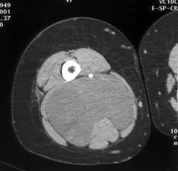 Liposarcoma - CTisus CT Scan